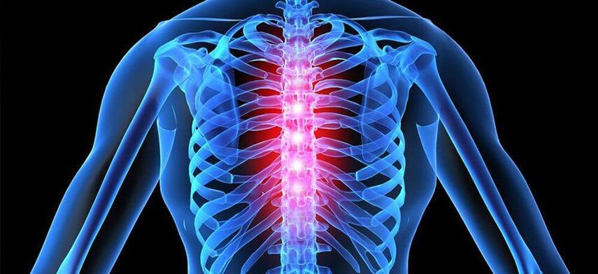 Ūmus skausmas būdingas krūtinės ląstos stuburo osteochondrozės paūmėjimui