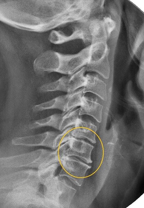 Osteochondrozė