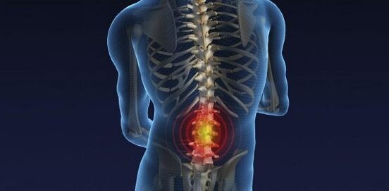 Nugaros skausmas su juosmens osteochondroze