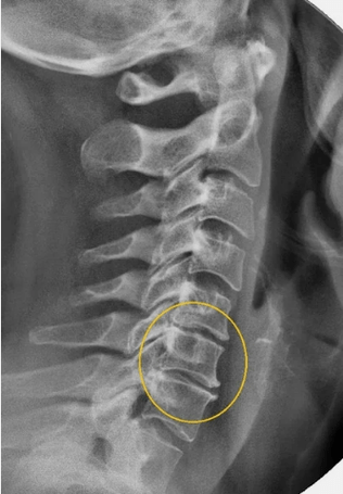 Gimdos kaklelio stuburo osteochondrozė