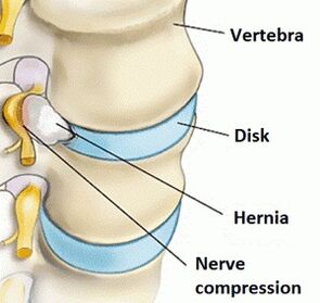 Gimdos kaklelio regiono osteochondrozė