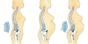 juosmens osteochondrozės vystymosi stadijos