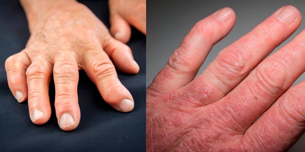 reumatoidinis ir psoriazinis rankų artritas