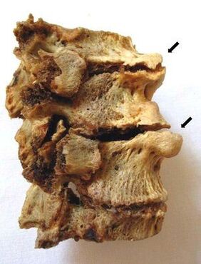 Stuburo dalis, paveikta osteochondrozės