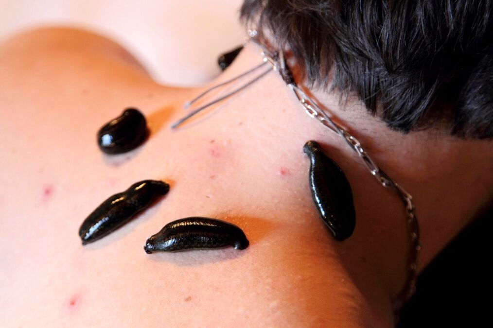 Dėlės nuo gimdos kaklelio osteochondrozės